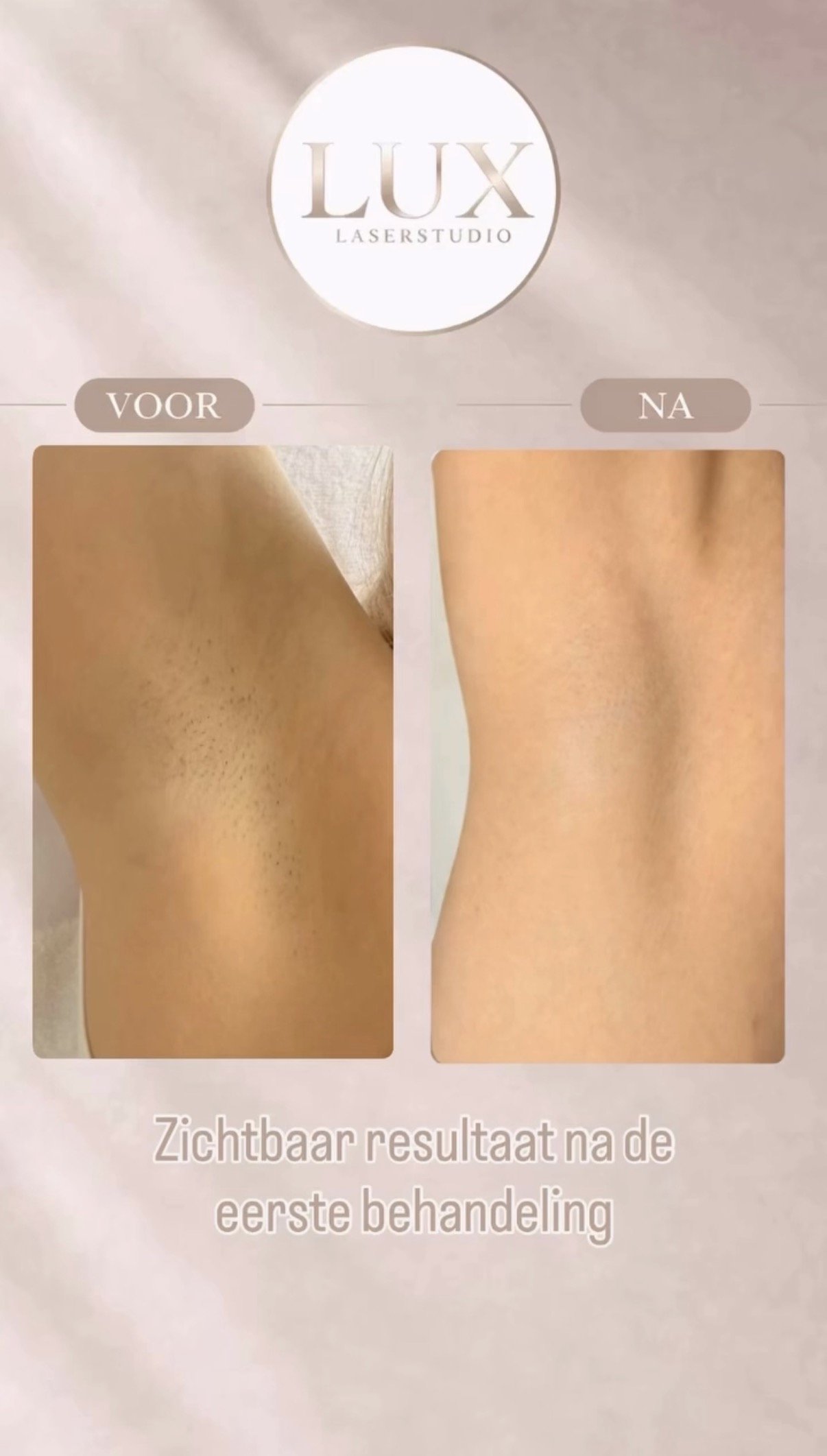 Instagram foto Lux Laserstudio